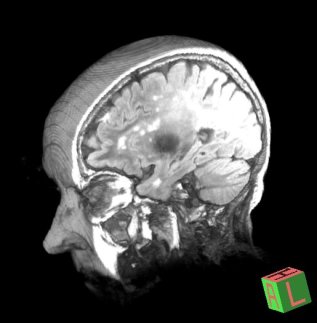 White spot on MRI scan - Neurology.