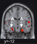 Claimed amygdala activation, which rather looks like collateral sulcus/entorhinal cortex... (from Bartels & Zeki 2004)